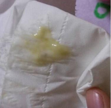 白带突然增多,很粘稠又有点淡黄色,这可能是初期慢性宫颈炎唯一的