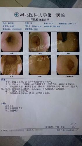 专栏| 有些胃息肉,治一治就能好.