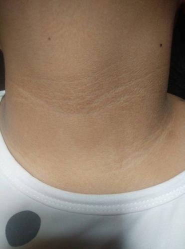 脖子一圈黑黑的,就像没洗干净的污垢,这到底是什么?怎么擦也擦不掉