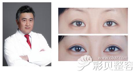 北京八大处王佳琦及其眼角修复案例