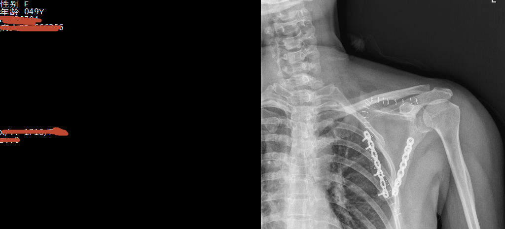一例肩胛骨骨折切开复位内固定手术治疗