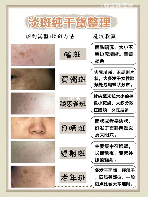 教你了解斑点的类型96长斑的原因96怎样祛斑96_祛斑_精华_有