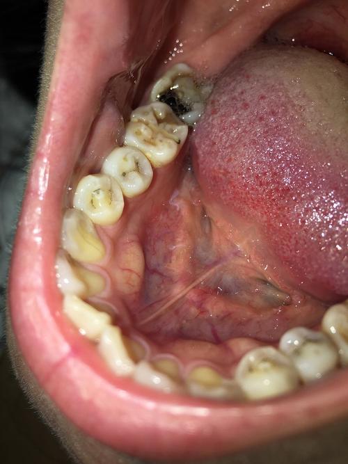 求救前辈们!后槽牙蛀空,填补物脱落,18号才能看上,现在疼到升天.