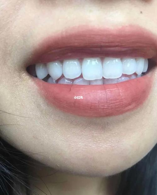 为什么总说我的牙是贴片或者烤瓷牙_磨牙_阅读_美牙_小仙女_口腔_贴面