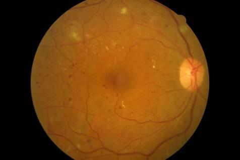 糖尿病患者请关爱您的眼睛 从定期的眼底检查做起