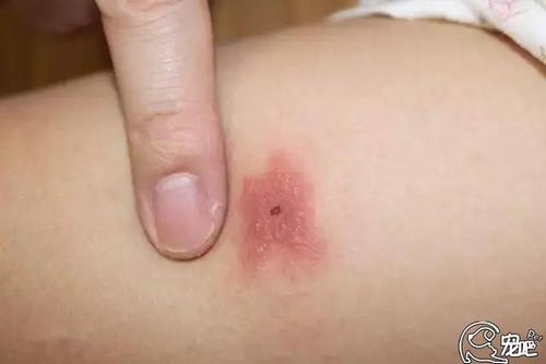医生怎么处理虫咬皮炎?