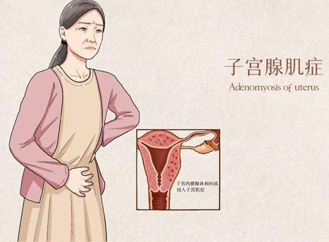 今天小编主要带大家了解子宫腺肌症的症状,以自查自己是否患有子宫腺