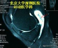 腘窝囊肿又叫baker囊肿,是膝关节后方包块最常见的原因.