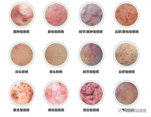 十二种不同的痘痘分类