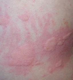 形成过敏性皮炎的危害