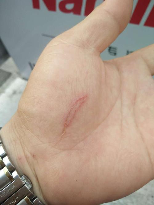 伙伴手掌受伤,用肽修复伤口,效果显著!