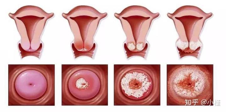 宫颈糜烂真的是"烂"了吗?