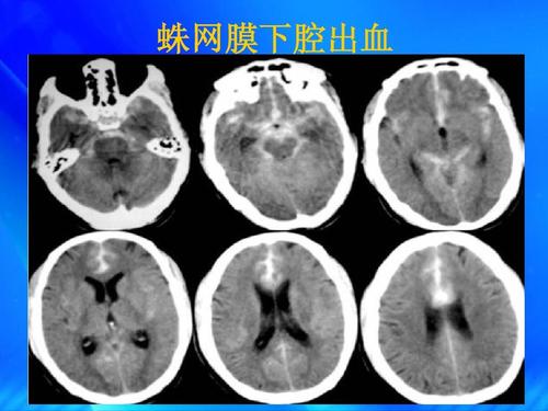 蛛网膜下腔出血