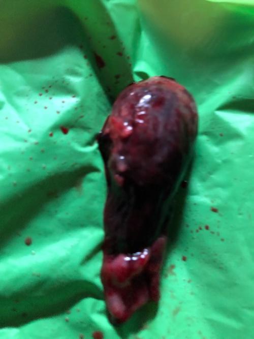 出血怀疑先兆流产腹痛一夜排出来的