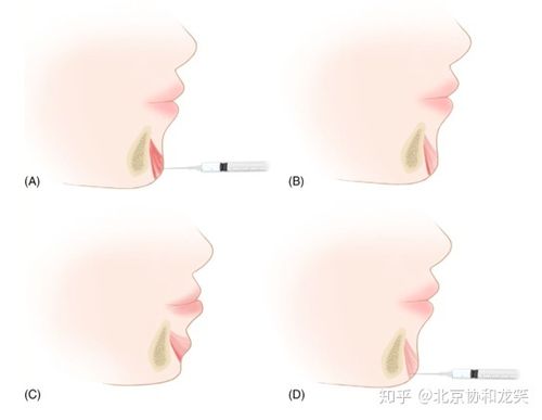 大师级病例讨论王晓军教授团队改进肉毒毒素颏肌注射方法