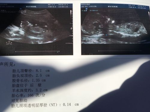         宝妈我十三周nt你会看吗?