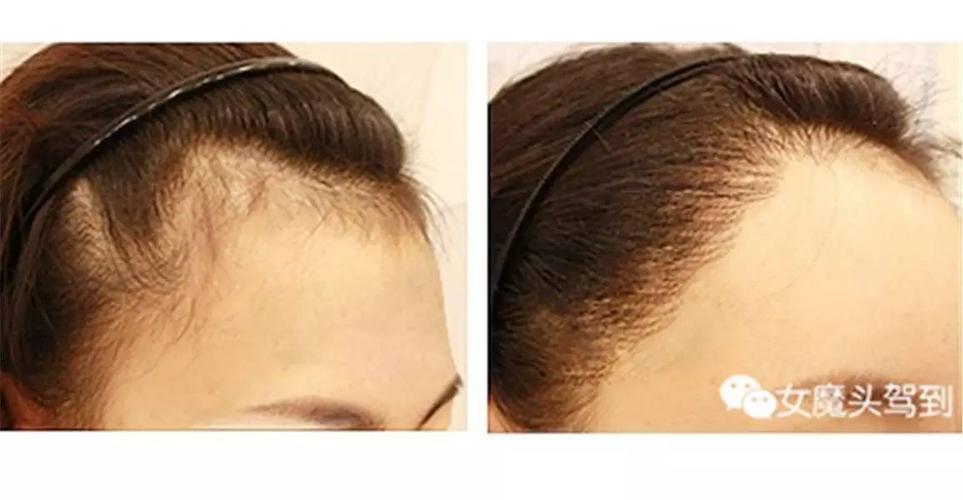 发际线过低者,发际线激光脱毛