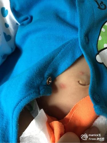 帮忙看看小孩肚脐长红点