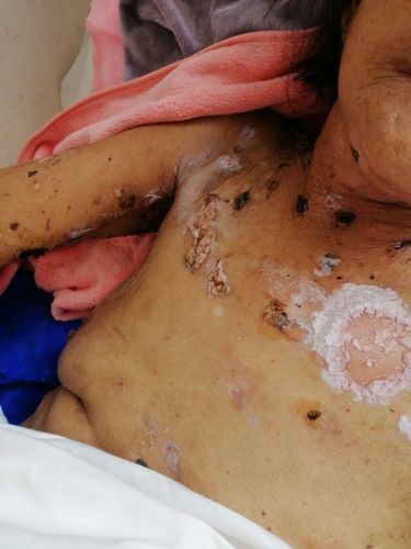 一例重症类天疱疮的治疗前后对比