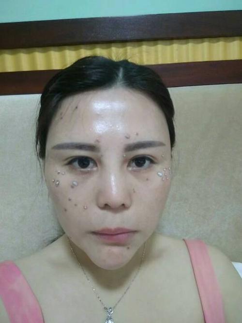 药水点斑后出现了大片的色素沉着,要多久可以恢复