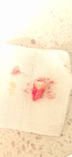 拔了一颗歪了的智齿〔血呼呼的图,慎入