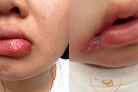 嘴角长疱疹图片 你知道如何预防吗