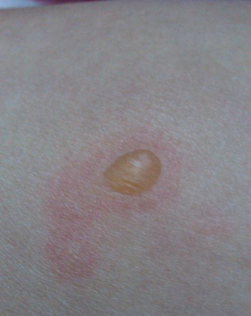 皮肤上长了一个水泡,皮肤科进