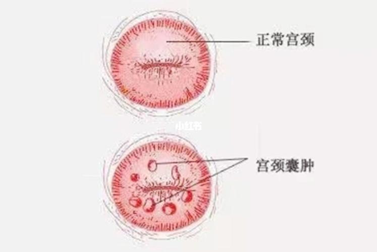 什么是宫颈纳氏囊肿,需要治 疗吗_御园a区攻略_妇科_医疗健康_医疗