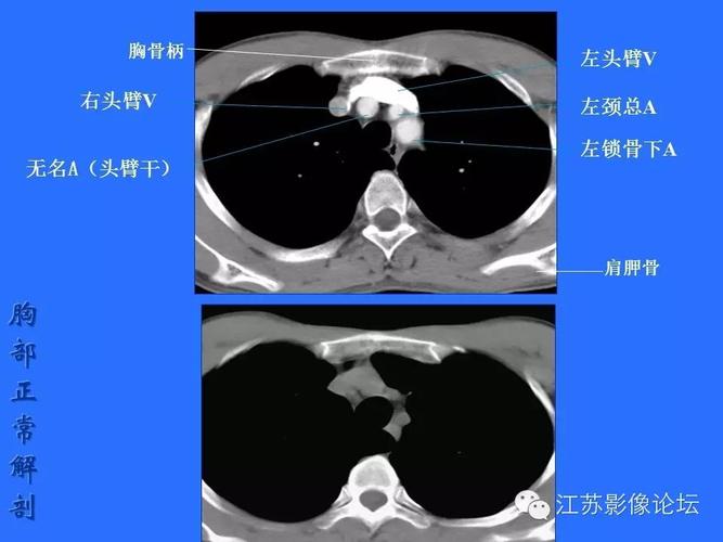 胸部正常解剖ct图详解【影像入门基础】