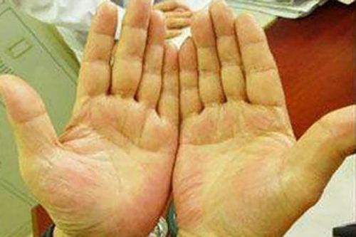 容易引发黄疸,大量的胆黄素随着血液循环到皮之后会使人的皮肤发黄