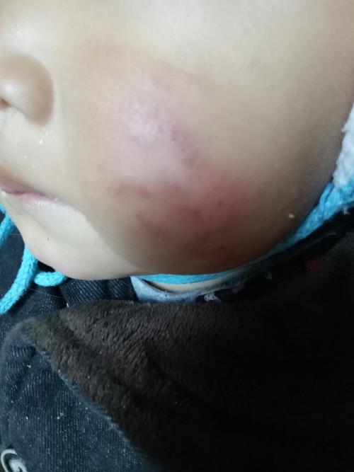 宝宝的脸上起了好多红疙瘩,像是冻得可是又不像冻得,有的结痂了但是