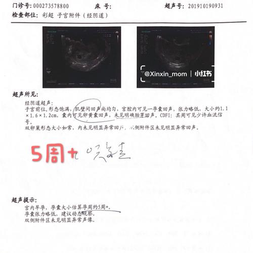 孕期nt和四维_胎儿_孕期_四维彩超_四维彩超照_母婴