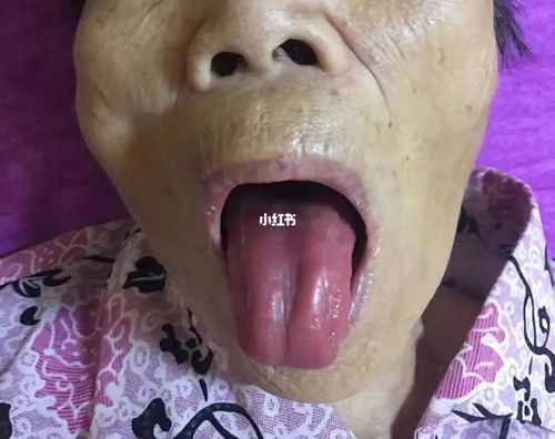 舌苔消失,胃阴虚,阴液暗耗严重,常常伴随阴虚不能制阳,阴虚火旺,内热