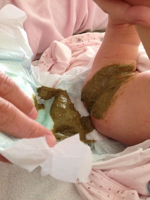 我家宝宝刚刚满月,可她今天都没拉大便,昨天也才拉一次,而且还是这样