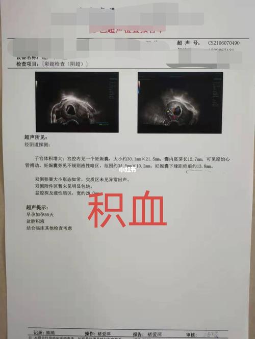 宫腔积血_备孕_怀孕_怀孕备孕接好孕_母婴_孕产经验