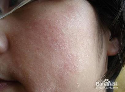 皮肤干燥_百度图片搜索