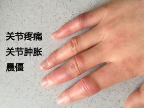 手关节肿痛怎么办