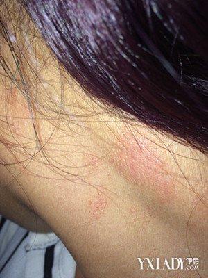 【图】脖子周围过敏怎么办 教你过敏的应急治疗方法