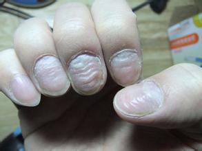 手指甲凹凸不平是咋回事?