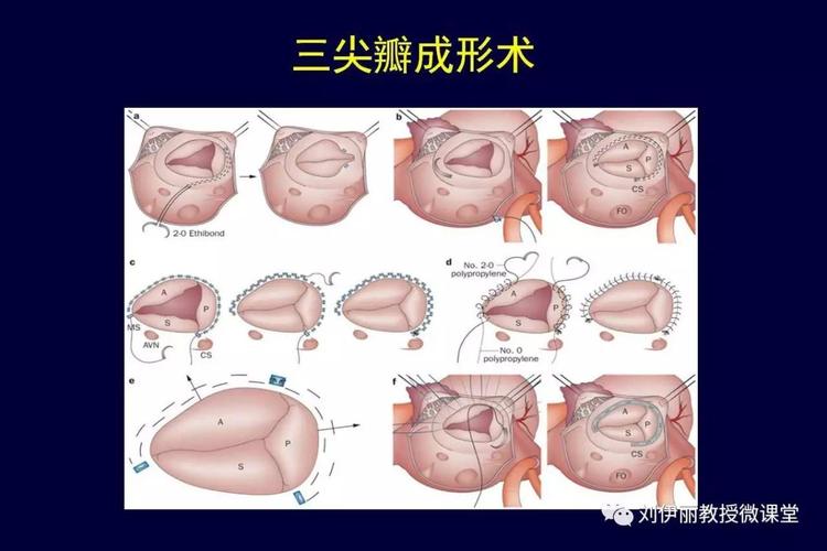 二尖瓣置换术后的三尖瓣关闭不全