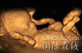 4维超声波成像能观察子宫内:胎儿在打哈欠(图)