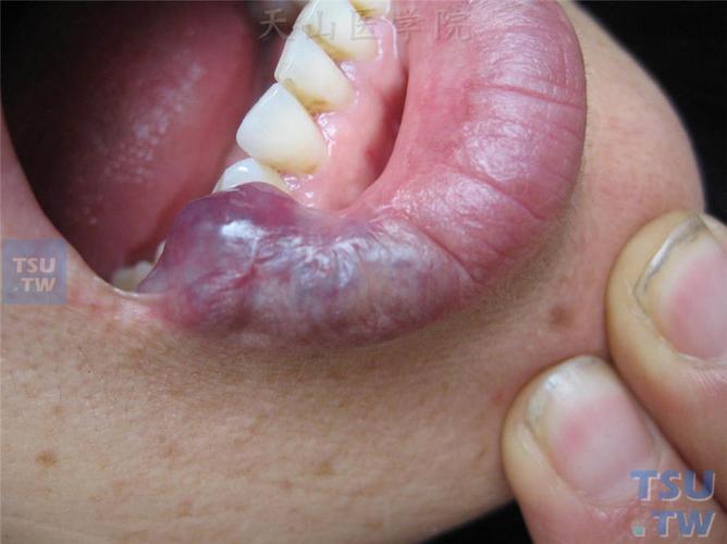 下一课内容拓展 流行性水肿(epidemic dropsy)又名老年性唇部血管瘤