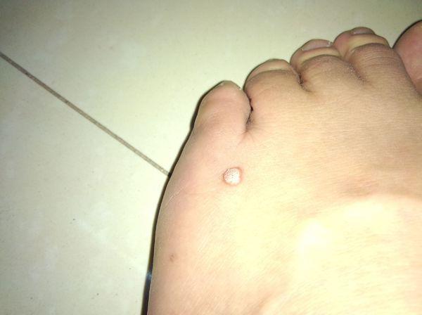 手指和脚背长了几个小瘤子,如以下图片,请