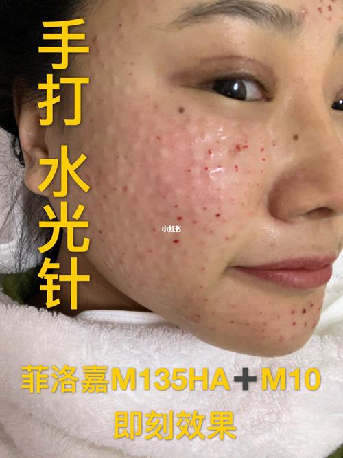 水光针 菲洛嘉 第二次手打 即刻效果_水光针_filorga怎么样_延缓衰老