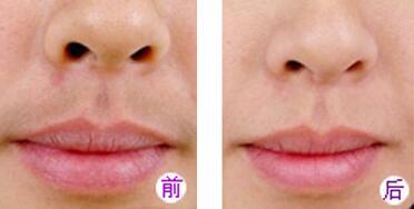 冰点脱唇毛术后护理要注意