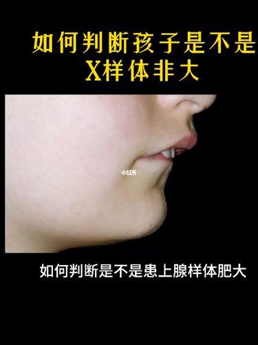 如何判断孩子是不是腺样体肥大_腺样体_鼻炎_鼻炎腺样
