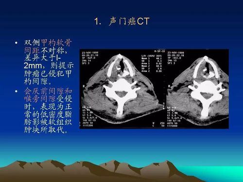 喉癌的ctmri诊断影像天地