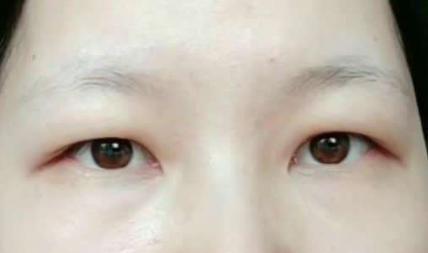 眼修复孙沣博士不同类型的眼肿泡该如何做双眼皮