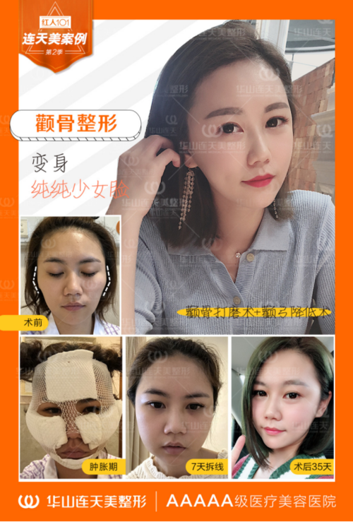 颧骨高必须要通过颧骨手术解决吗?   颧骨高,要根据具体原因解决.