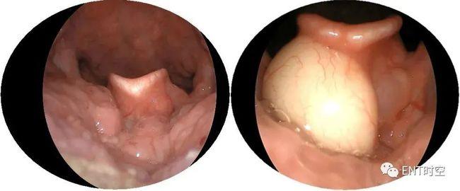 实用鼻内镜下等离子射频会厌囊肿切除术